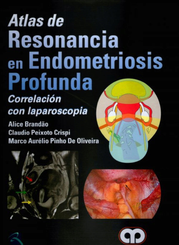 Alice Brandão. Atlas de Resonancia en Endometriosis Profunda. 1ra ed. 2016
