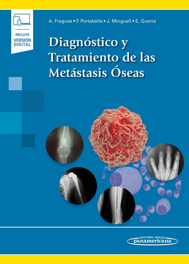 Fraguas I Castany. Antonio. Diagnóstico y tratamiento de las metástasis oseas. 1a ed. 2021