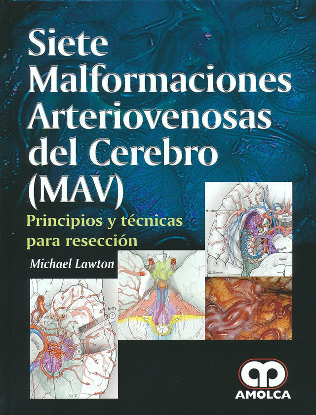 Michael T. Lawton. Siete Malformaciones Arteriovenosas del Cerebro (MAV). 1a. ed. 2017
