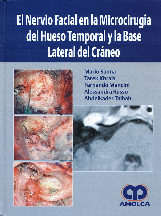 Mario Sanna. El Nervio Facial en la Microcirugía del Hueso Temporal. 1a. ed. 2018