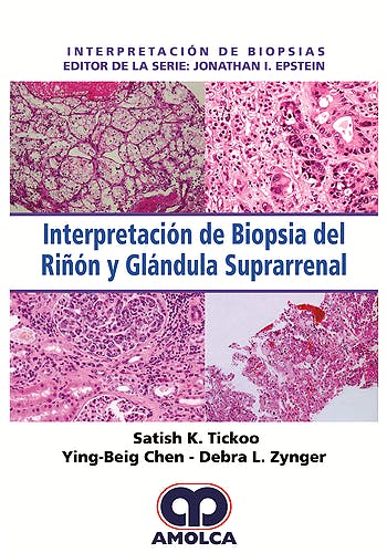 Satish K. Tickoo. Interpretación de Biopsias del Riñón y Glándula Suprarrenal. 1a. ed. 2018
